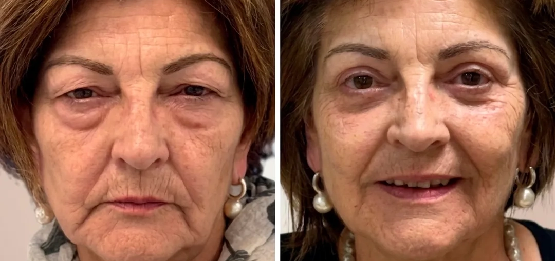 Our surgeon, Santiago Elvira, explains on Antena 3 the aesthetic procedures setting the trend