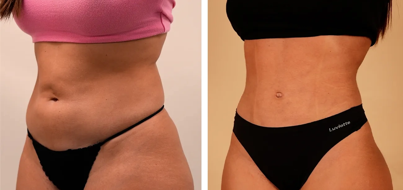 Our surgeon, Santiago Elvira, explains on Antena 3 the aesthetic procedures setting the trend