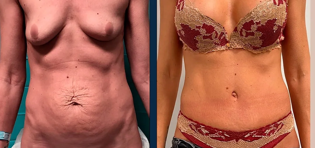 Our surgeon, Santiago Elvira, explains on Antena 3 the aesthetic procedures setting the trend