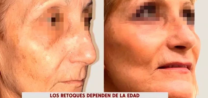 Cirugía estética en adultos: nuestro cirujano, Tiago Gomes, lo explica en Cuatro 