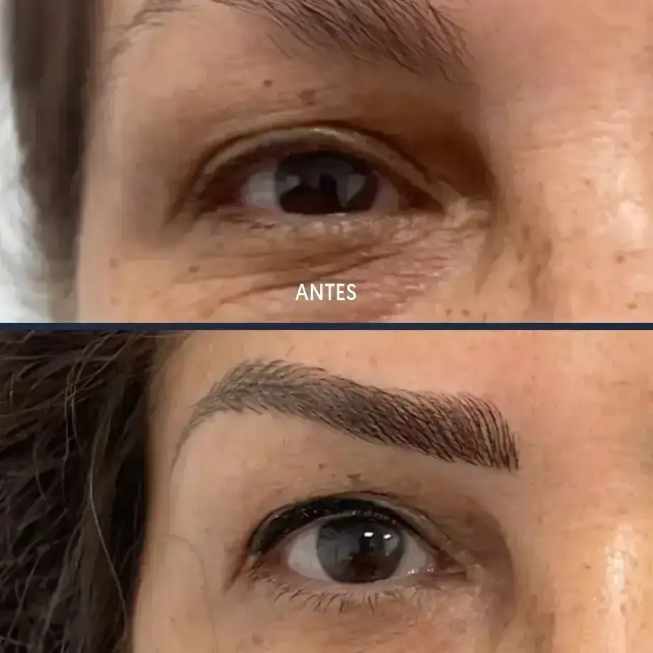 ¿Quién es el paciente Ideal para el nanoblading?