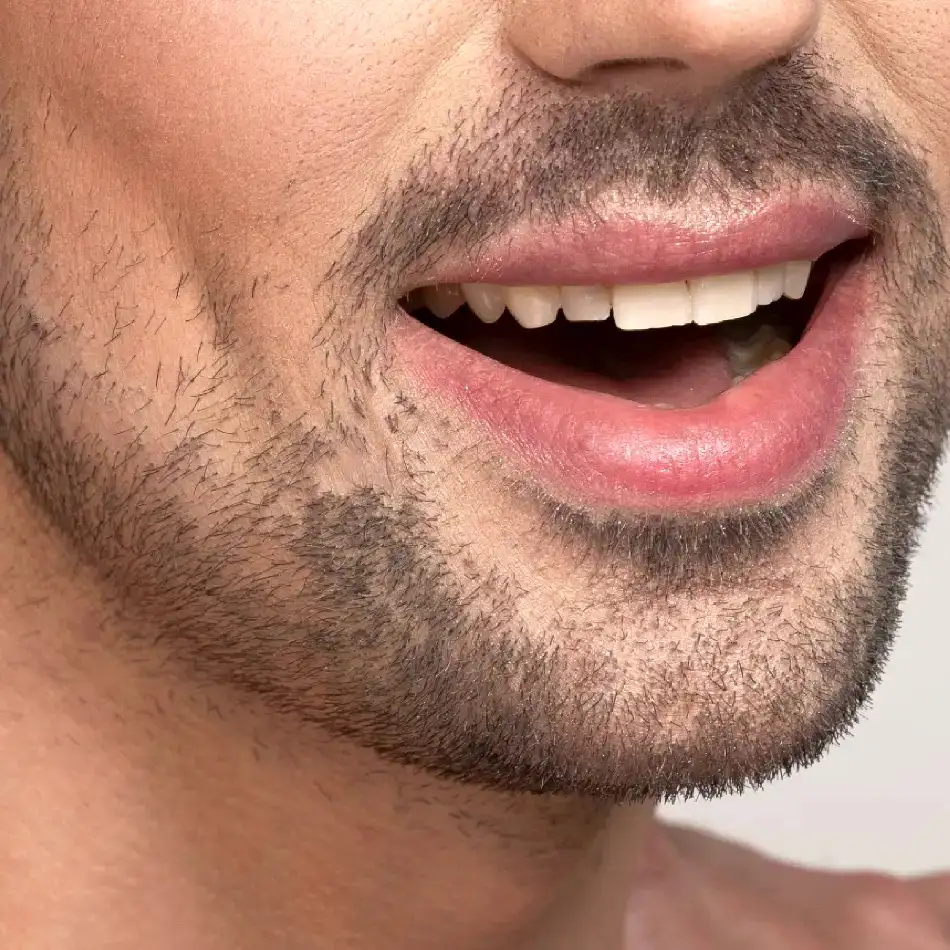 ¿Qué es la marcación mandibular con ácido hialurónico?