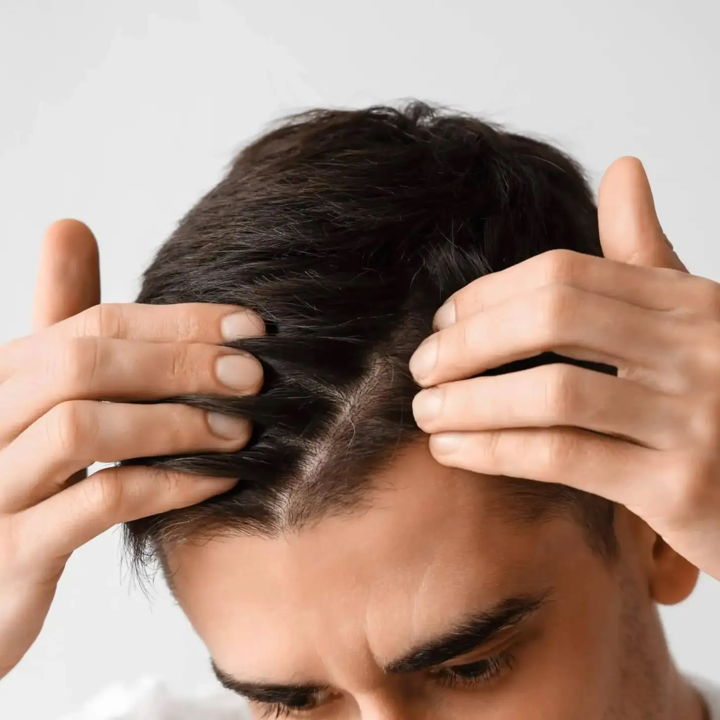 ¿Cuál es el precio de un injerto capilar?