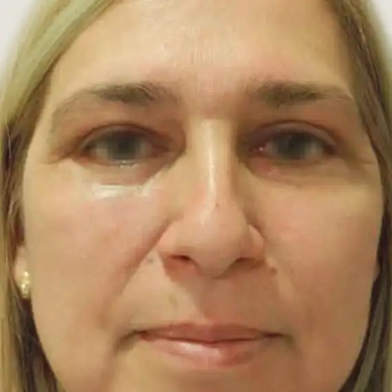 Después de Antes y después de una Blefaroplastia