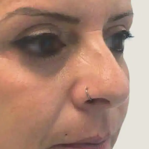 Después de Antes y después de una Blefaroplastia