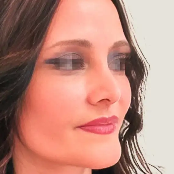 Después de Antes y después del lifting facial