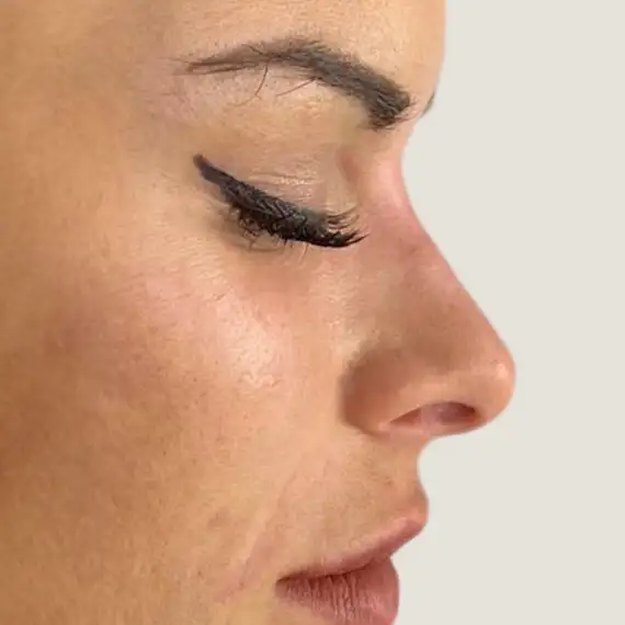 Después de Rhinomodeling