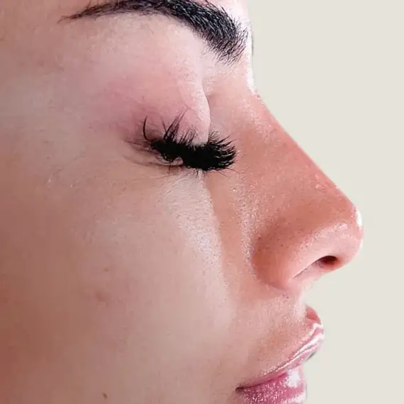 Después de Rhinomodeling