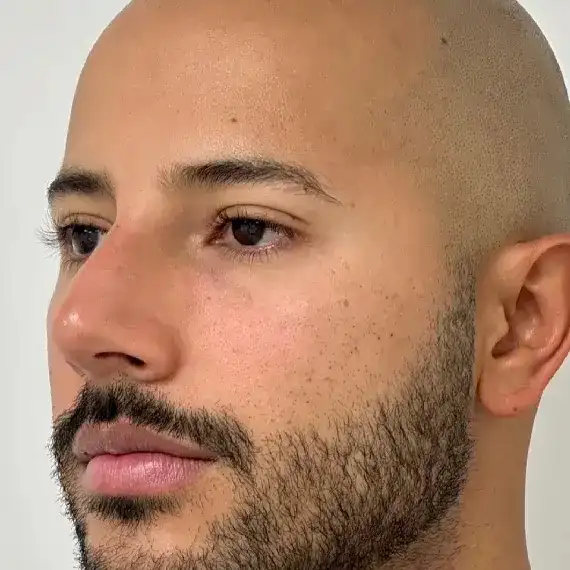 Después de Relleno de ojeras