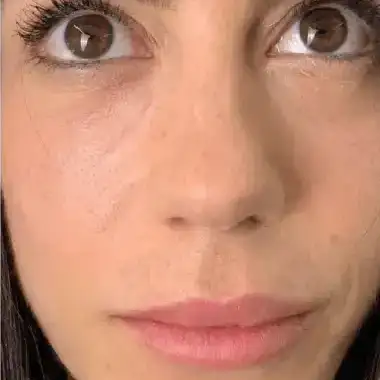 Después de Micropigmentación Ojeras