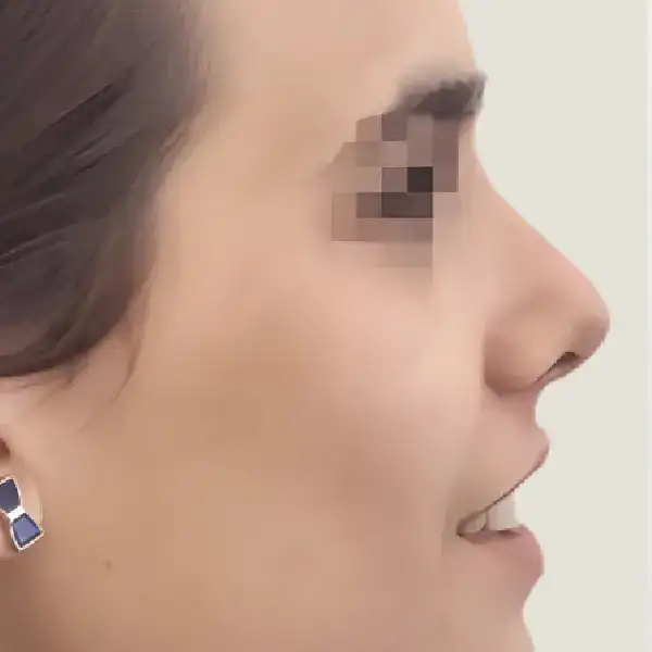 Después de Rinoplàstia secundària