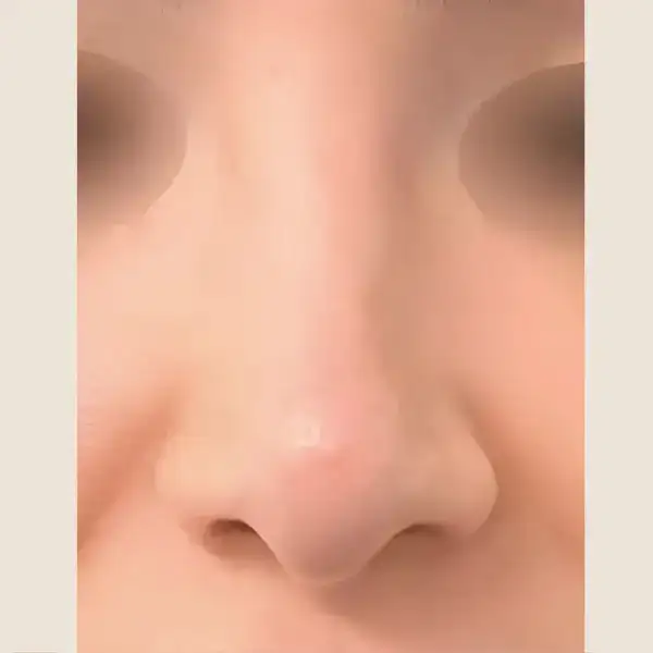 Después de Rinoplàstia secundària