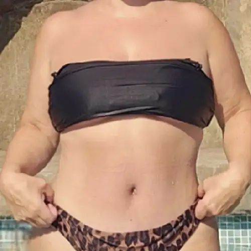 Después de Liposucción VASER