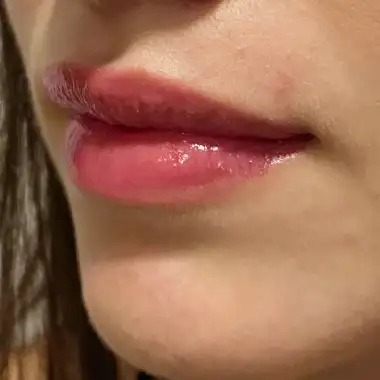 Después de Micropigmentación de Labios