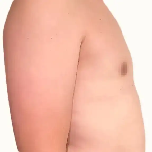 Después de Ginecomastia