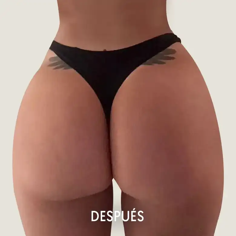 Después de Aumento de glúteos