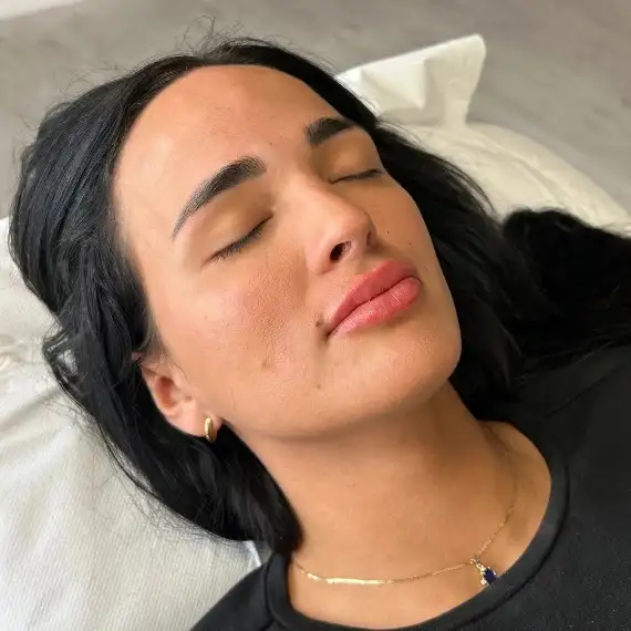 Después de Relleno de labios