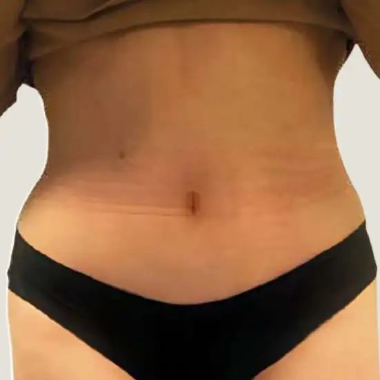 Después de Lipoescultura