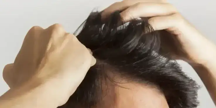 Cirugía capilar: Toda la información