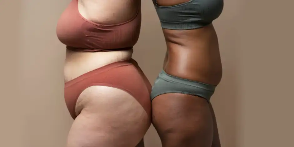 Todo sobre el lipedema: qué es y cómo se trata