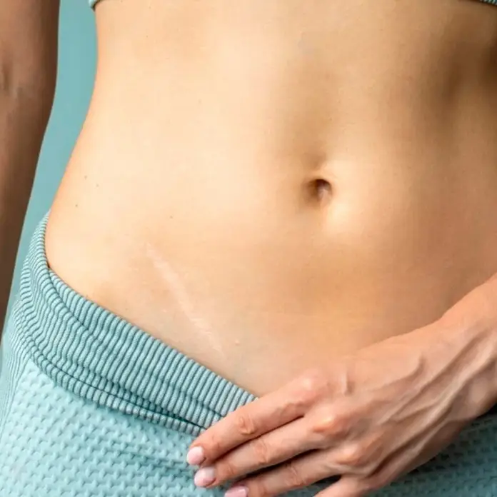 Eliminar cicatrices: Luce una piel sin imperfecciones.