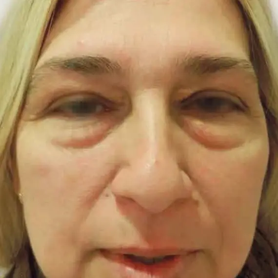Antes de Antes y después de una Blefaroplastia