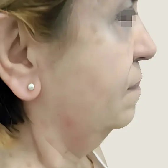 Antes de Liposucción de papada