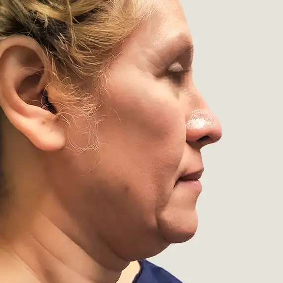 Antes de Liposucción de papada