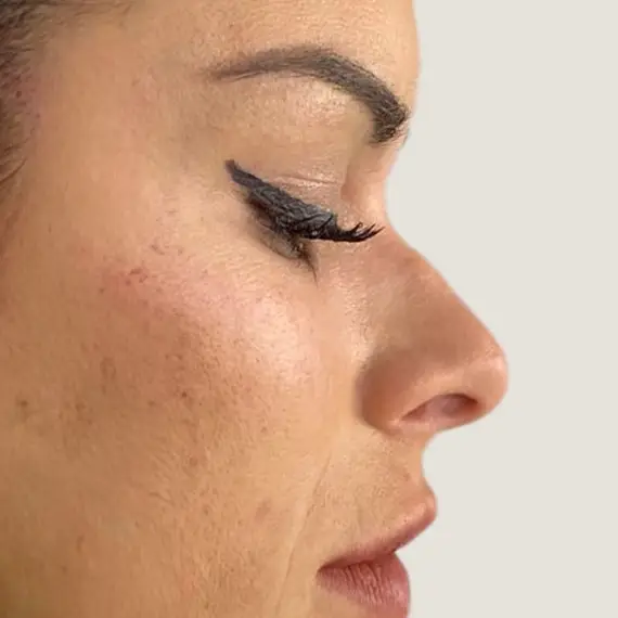 Antes de Rhinomodeling