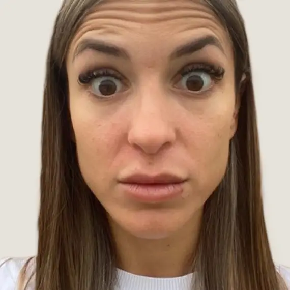 Antes de Tratamiento de arrugas de expresión