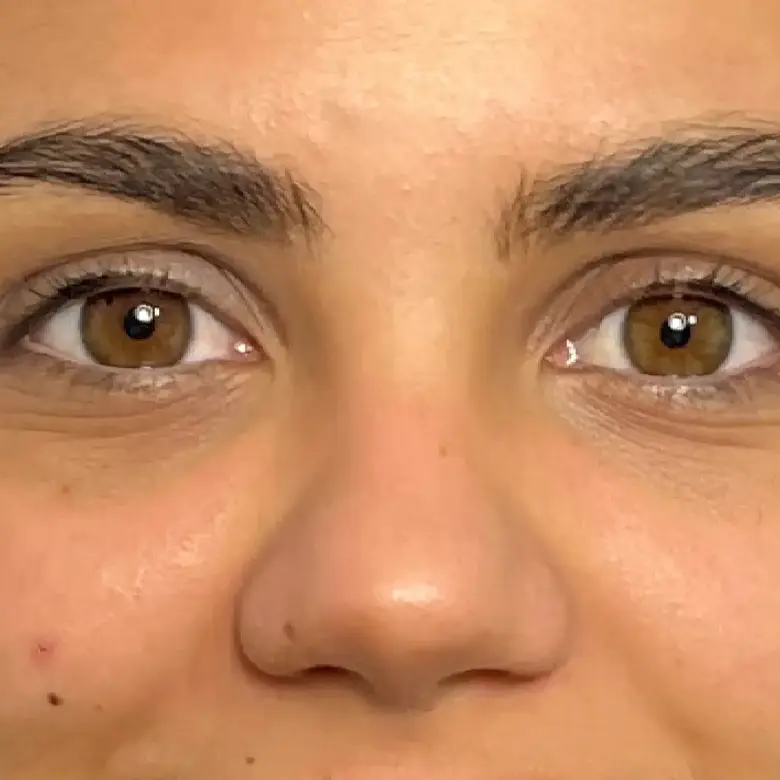 Antes de Relleno de ojeras