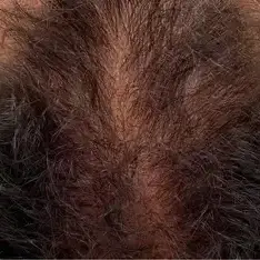 Antes de Mesoterapia Capilar