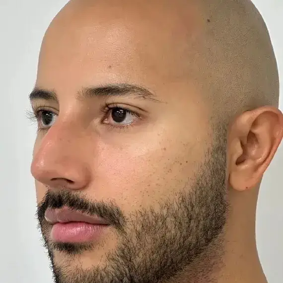 Antes de Relleno de ojeras