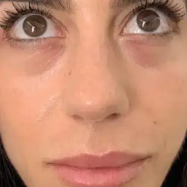 Antes de Micropigmentación Ojeras