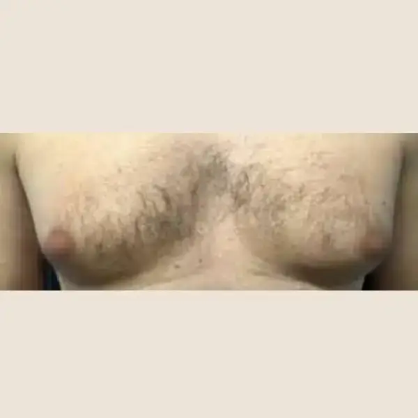 Antes de Ginecomastia