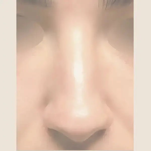 Antes de Rinoplàstia secundària