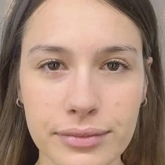 Antes de Nanoblanding