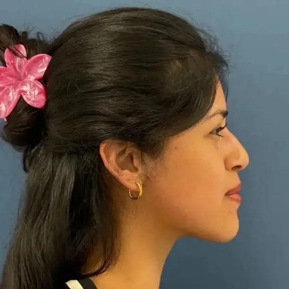 Antes de Rinoplastia ultrasónica