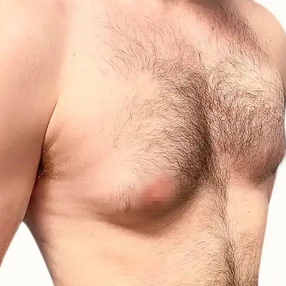 Antes de Ginecomastia