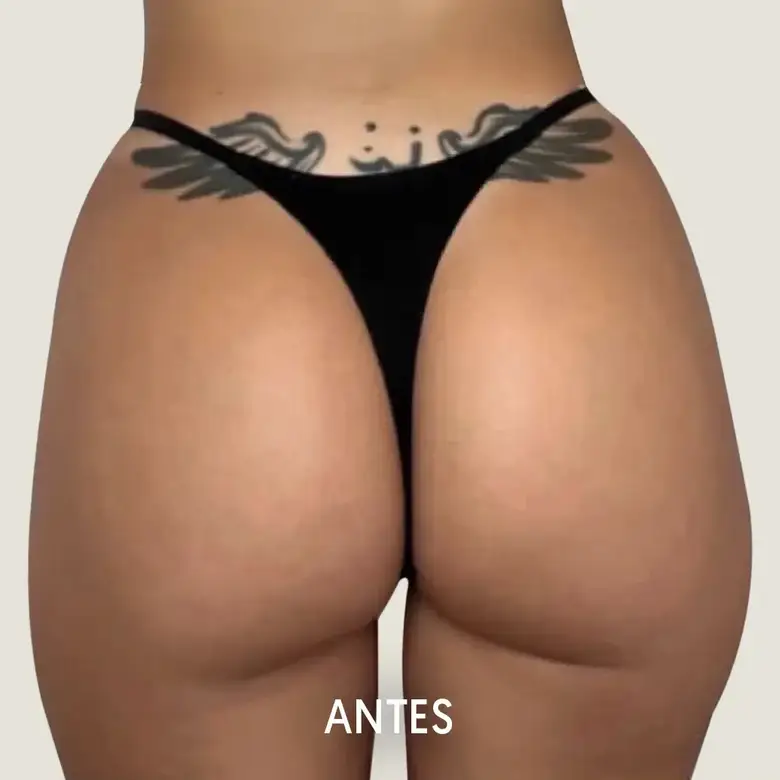 Antes de Aumento de glúteos