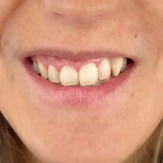 Antes de Sonrisa gingival