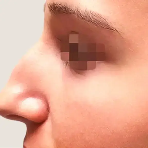 Antes de Rinoplastia ultrasónica