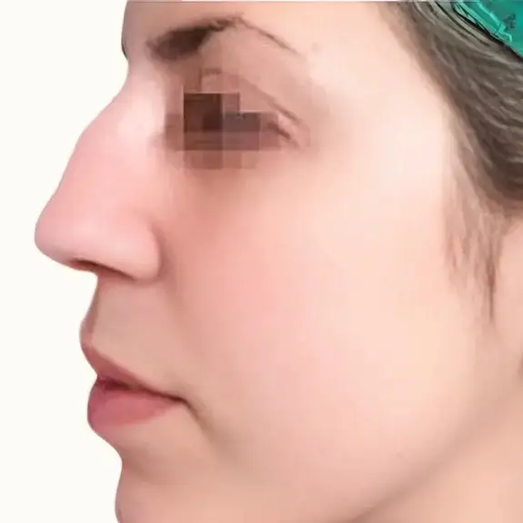 Antes de Rinoplastia ultrasónica