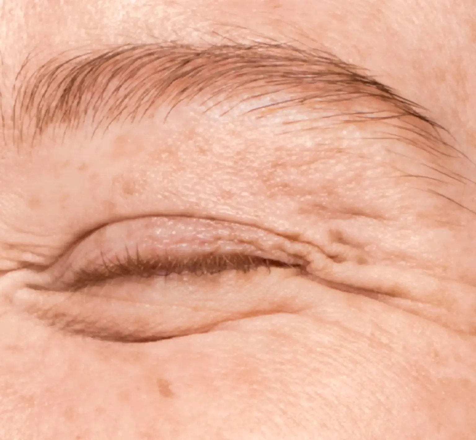 Eliminar arrugues d'expressió: llueix 10 anys més jove