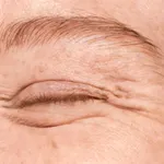 Eliminar arrugues d'expressió: llueix 10 anys més jove