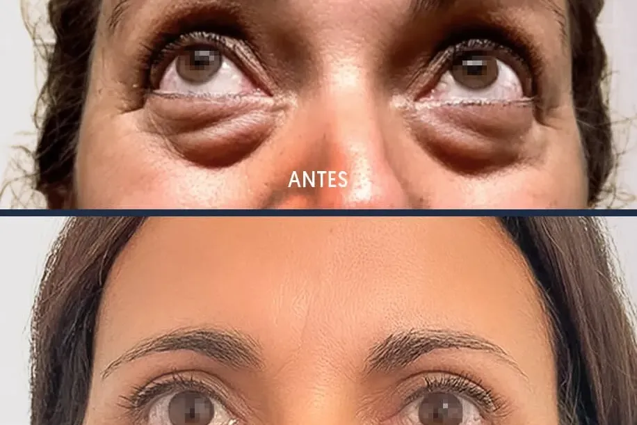 ¿Pueden volver a salir las bolsas tras la blefaroplastia?