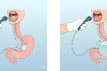 ¿Cómo funciona el balón gástrico?