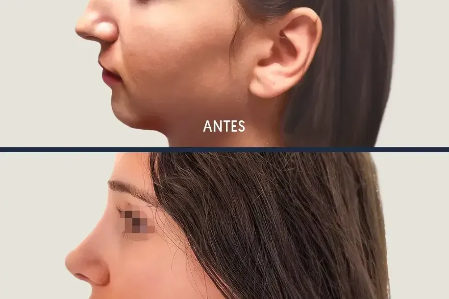 Nas aguilenc: Com canviar-ne la forma sense perdre la teva essència