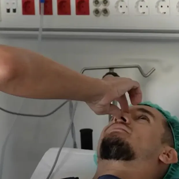 Miguel nos habla de su rinoplastia