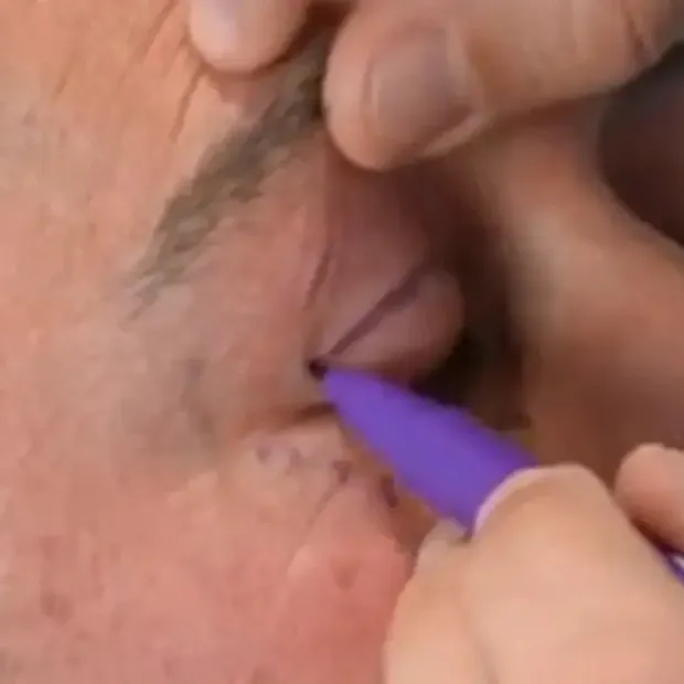 Vicente experiencia y caso real de blefaroplastia